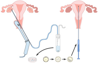 Embryo Transfer Everything You Need To Know From A Fertility Doctor The Lucky Egg